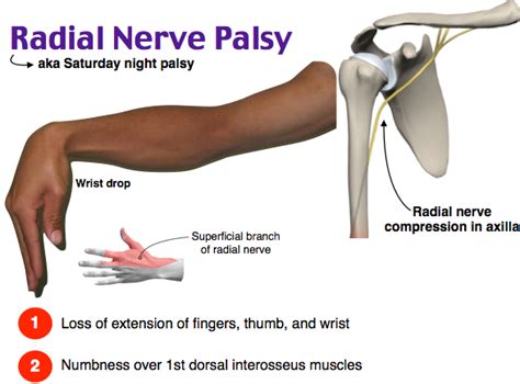 treatment of radial nerve compression